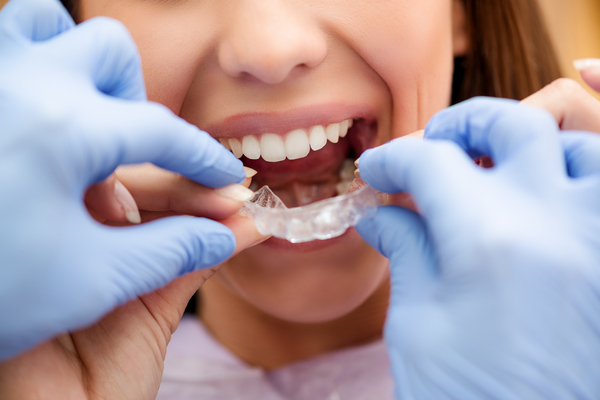 Blog 16 Apparecchio dentale
