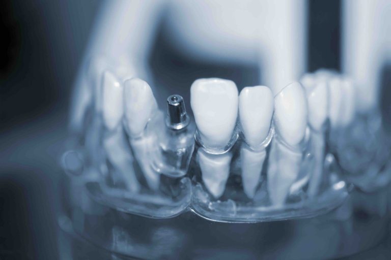 Blog 15 Impianti dentali a Firenze
